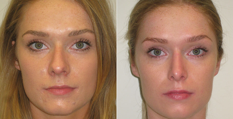 Rhinoplasty Before & After Photo