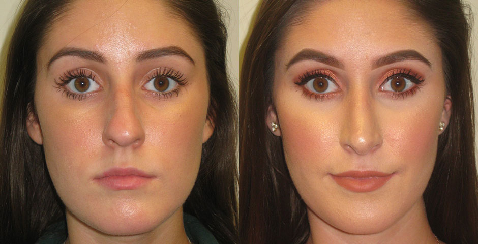 Rhinoplasty Before & After Photo