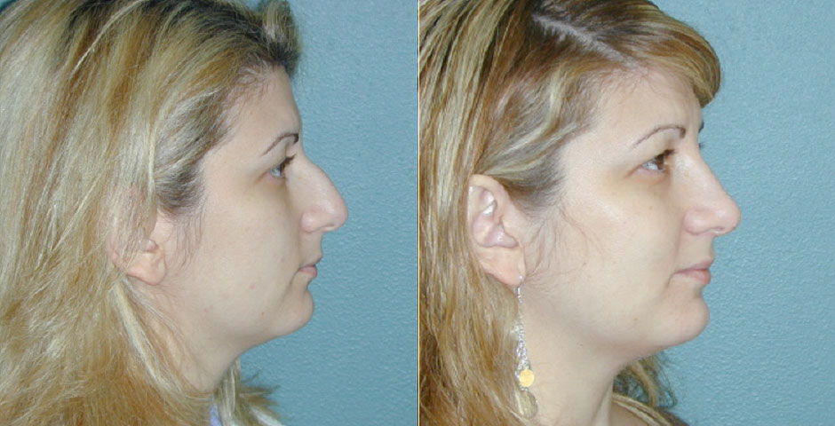 Rhinoplasty Before & After Photo