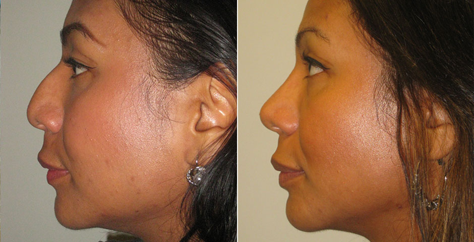 Rhinoplasty Before & After Photo