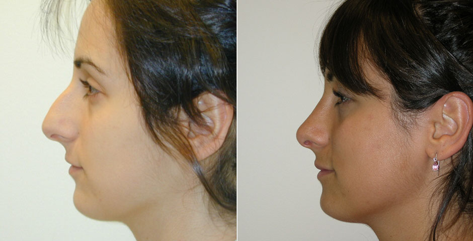 Rhinoplasty Before & After Photo