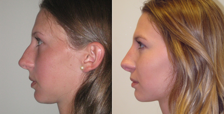 rhinoplasty-gallery_2