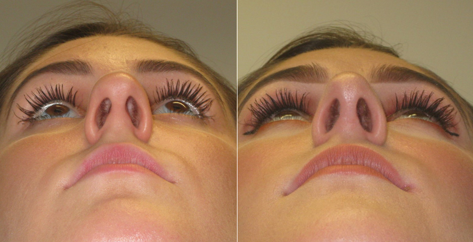 rhinoplasty-gallery_5