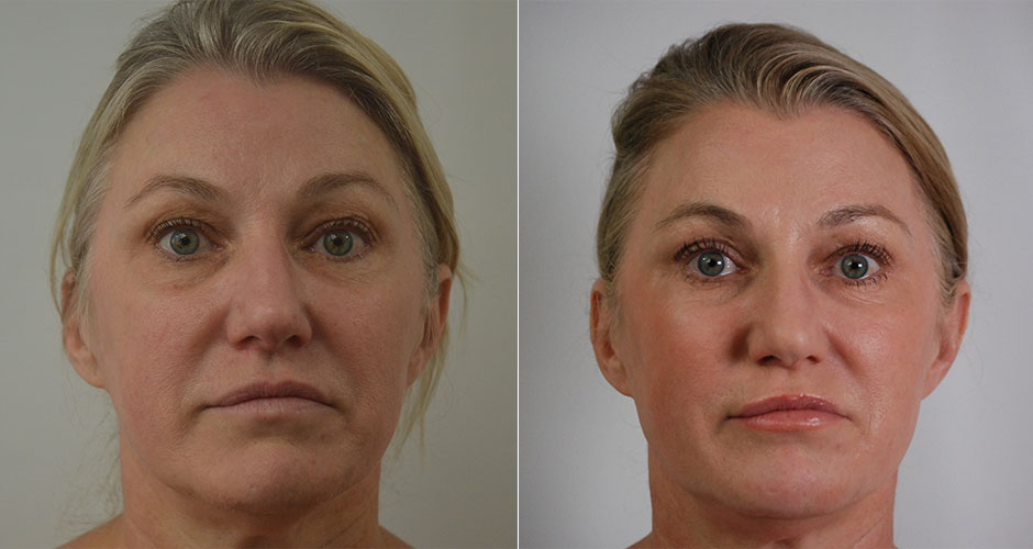 SoftLift Facial Rejuvination Before & After Photo