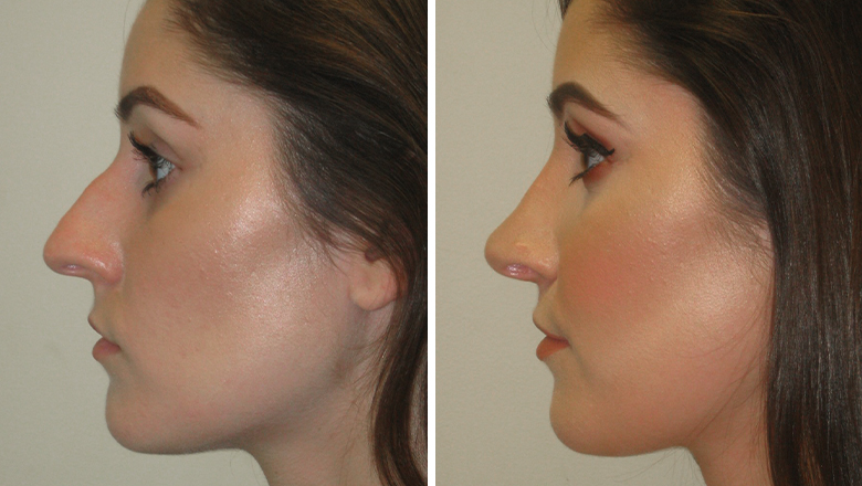 before and after nose job photos