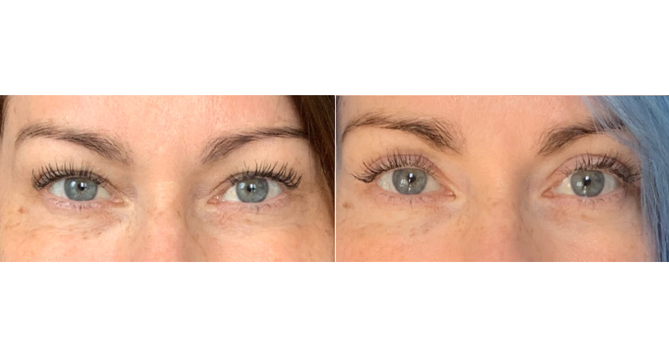 Blepharoplasty Before and After Photo