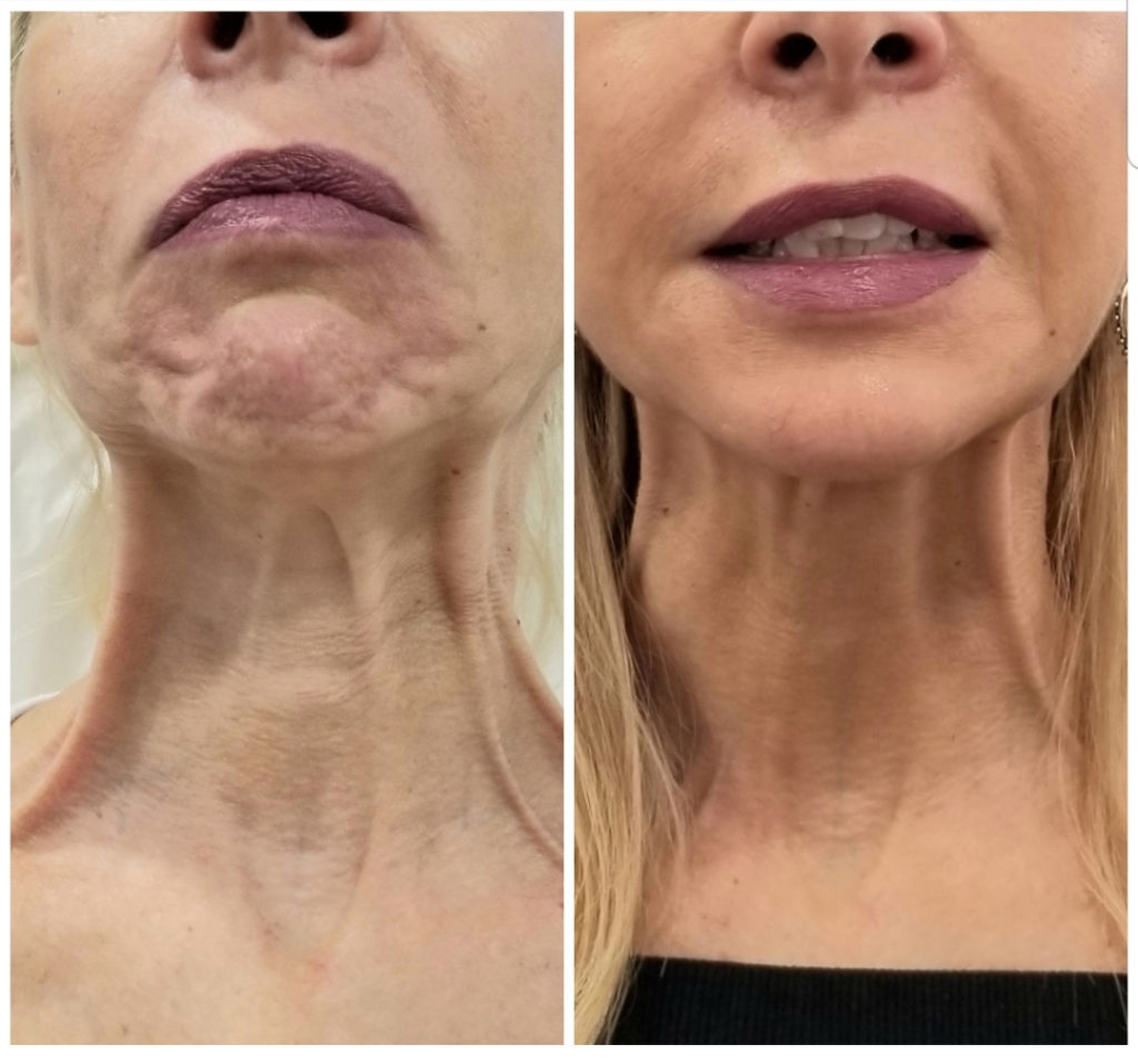 Neck Rejuvenation Before and After Photo