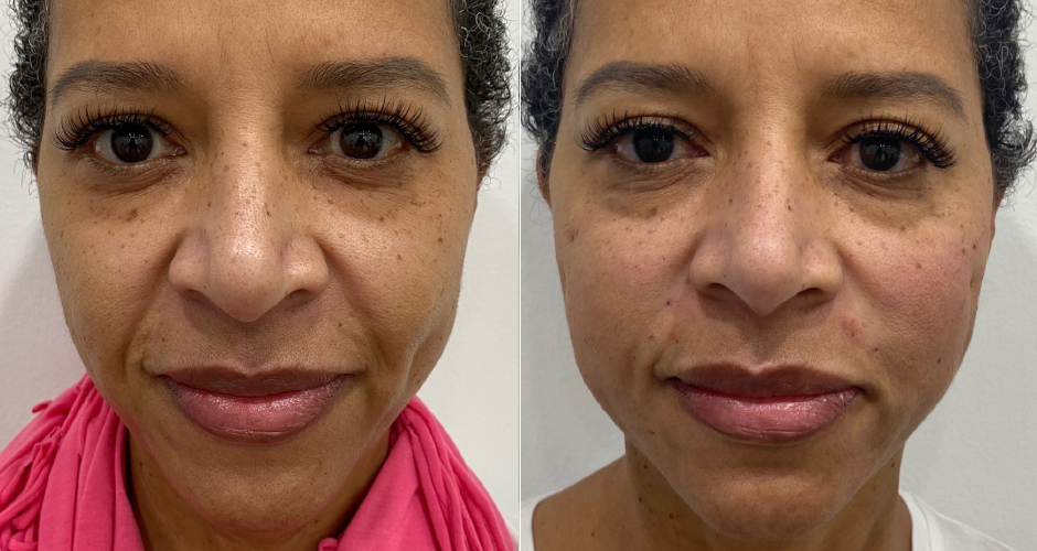 Thread Lift Before and After Photo