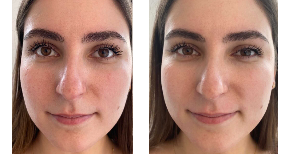 Miracle 10 Peel Treatment Before and After Photo