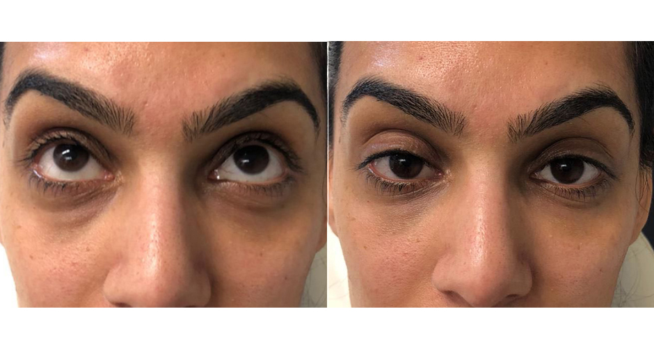 Redensity II Under Eye Treatment Before & After Photo